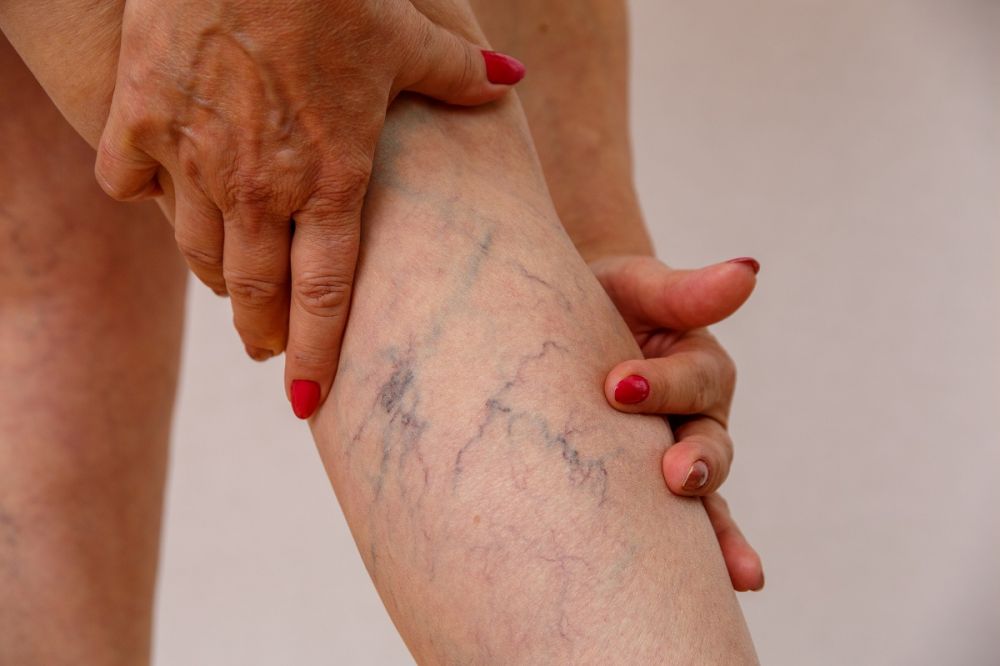 Elderly woman in white panties shows cellulite and varicose vein